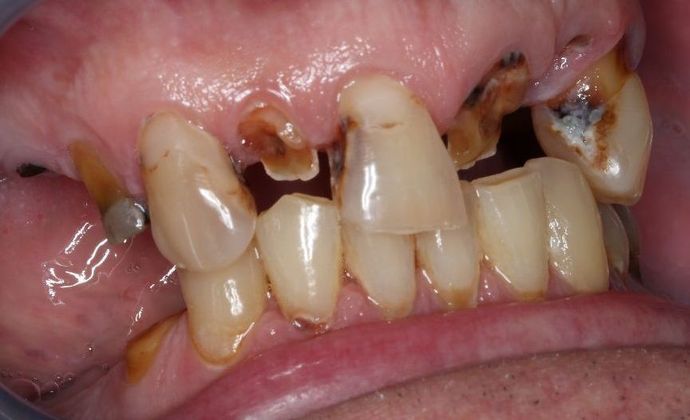 Dentures: Case 3 - Before