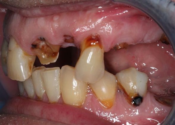 Dentures: Case 3 - Before
