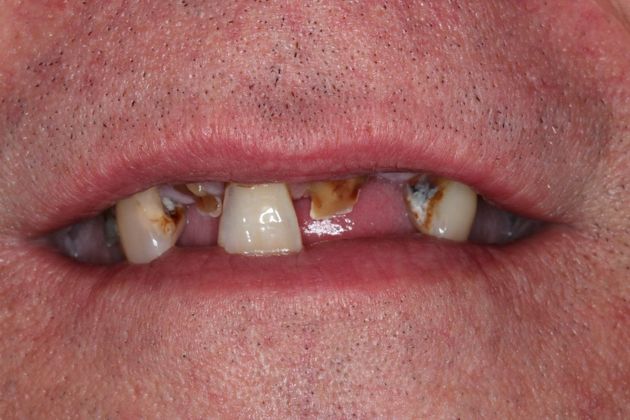 Dentures: Case 3 - Before