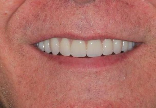 Dentures: Case 3 - After