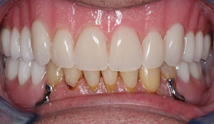 Dentures: Case 3 - lower partial Upper denture
