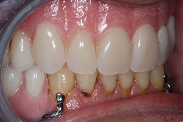 Dentures: Case 3 - After
