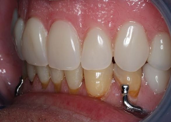 Dentures: Case 3 - After