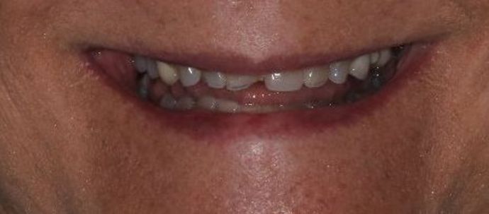 Dental Crowns Case 26 - Before