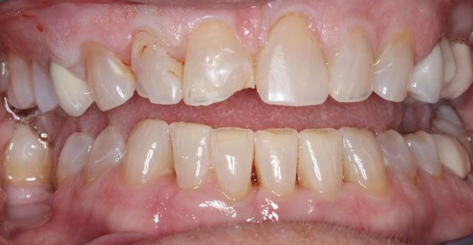 Dental Crowns: Case 26 - Before
