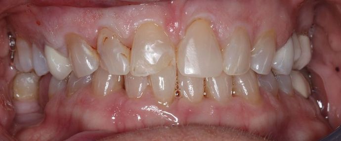 Dental Crowns: Case 26 - Before