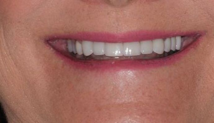 Dental Crowns Case 26 - After