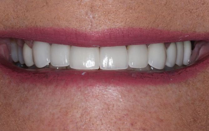 Dental Crowns: Case 26 - After