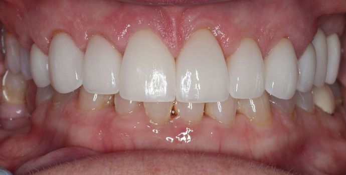 Dental Crowns: Case 26 - After