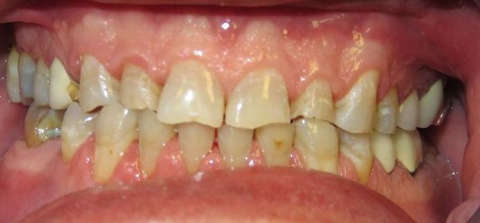 Full Mouth Reconstruction: Case 4 - Before
