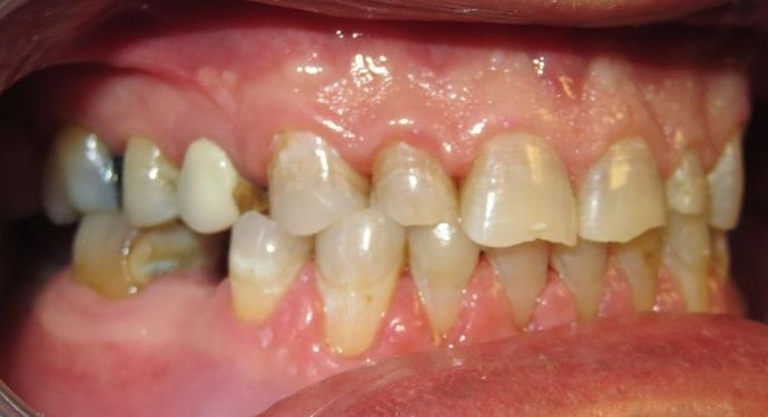 Full Mouth Reconstruction: Case 4 - Before