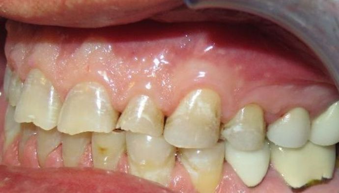 Full Mouth Reconstruction: Case 4 - Before