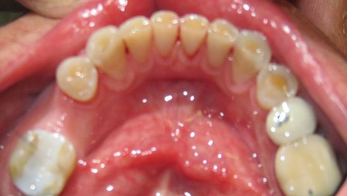 Full Mouth Reconstruction: Case 4 - Before