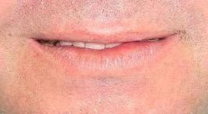 Full Mouth Reconstruction Case 4 - Before