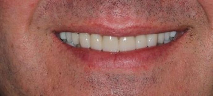 Full Mouth Reconstruction Case 4 - After