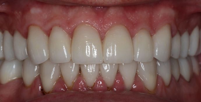Full Mouth Reconstruction: Case 4 - After