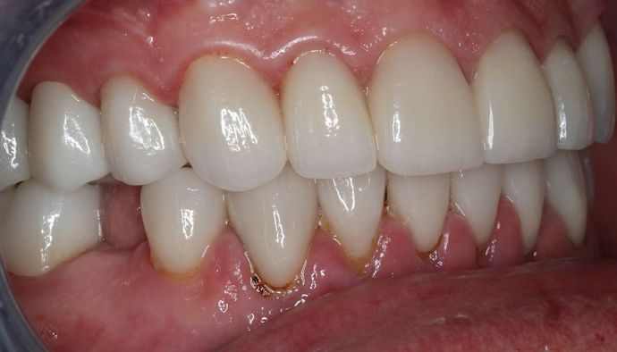 Full Mouth Reconstruction: Case 4 - After