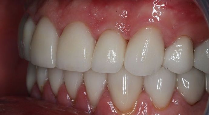 Full Mouth Reconstruction: Case 4 - After