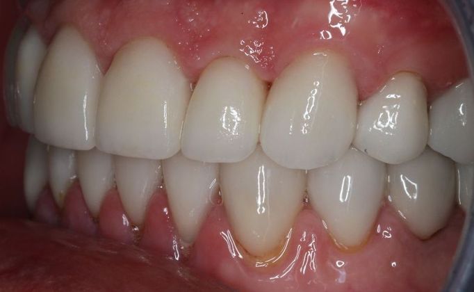 Full Mouth Reconstruction: Case 4 - After