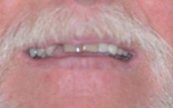 Dental Crowns Case 27 - Before