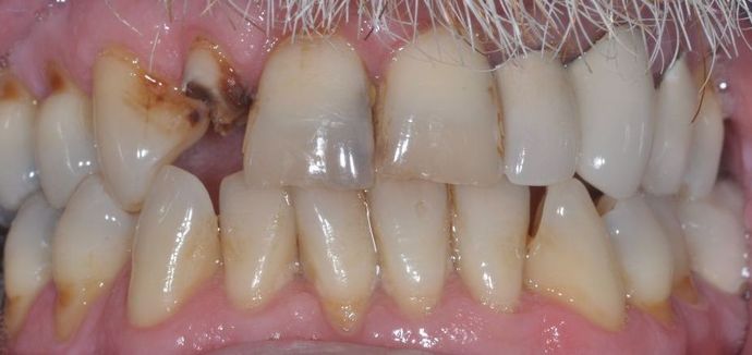 Dental Crowns: Case 27 - Before