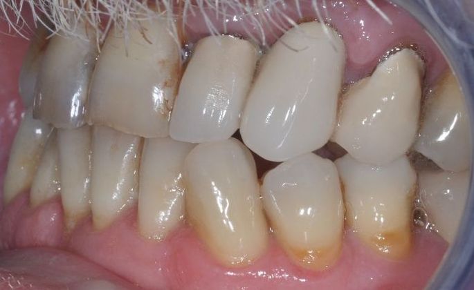 Dental Crowns: Case 27 - Before