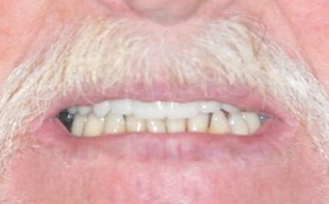 Dental Crowns Case 27 - After