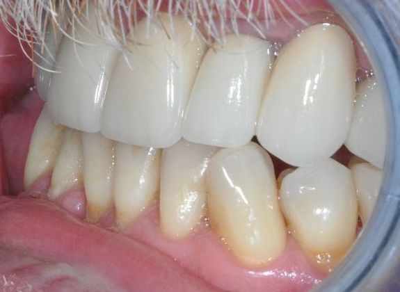 Dental Crowns: Case 27 - After