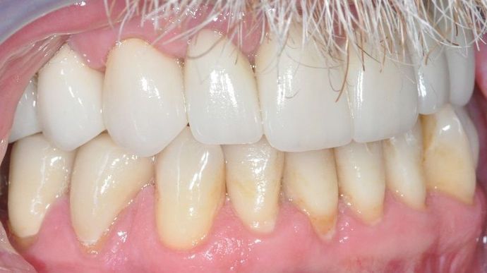 Dental Crowns: Case 27 - After