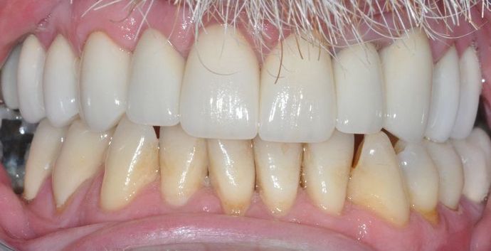 Dental Crowns: Case 27 - After