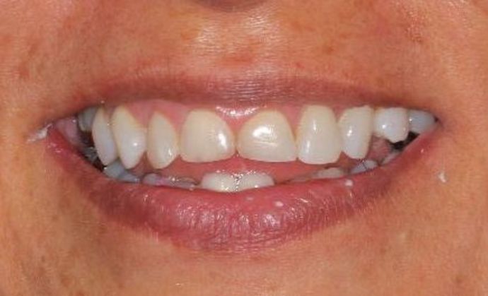 Veneers Case 16 - Before