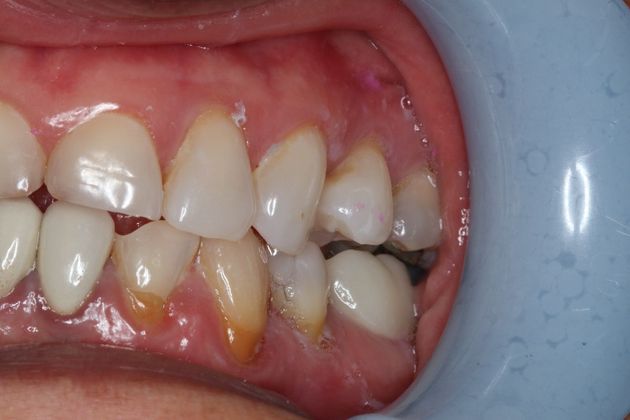 Veneers: Case 16 - Before