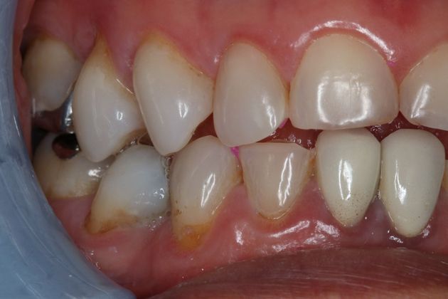 Veneers: Case 16 - Before