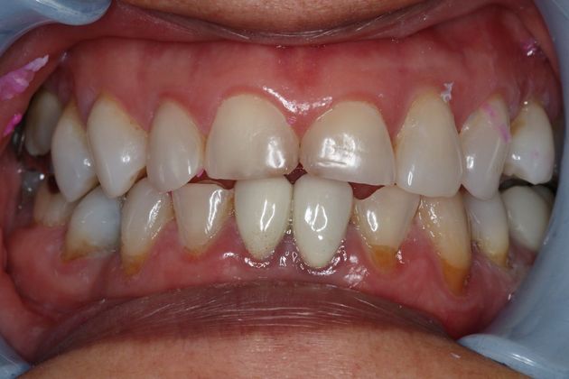 Veneers: Case 16 - Before