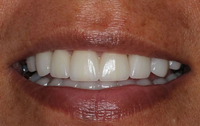 Veneers Case 16 - After