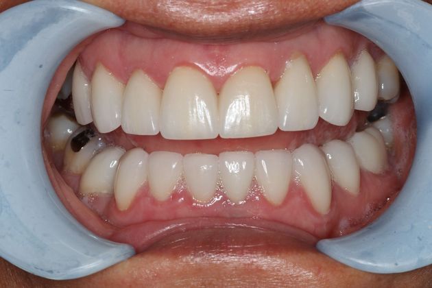 Veneers: Case 16 - After