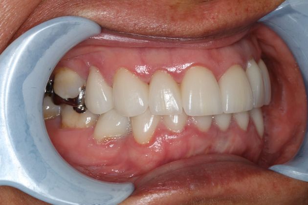 Veneers: Case 16 - After