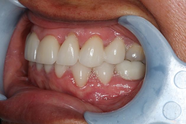 Veneers: Case 16 - After