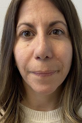 Rhinoplasty: Case 24 Revision Rhinoplasty Westport, CT - After