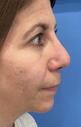 Rhinoplasty: Case 24 Revision Rhinoplasty Westport, CT - Before