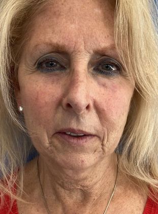 Rhinoplasty Case 25 Rhinoplasty Fairfield, CT - Before