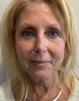 Rhinoplasty Case 25 Rhinoplasty Fairfield, CT - After