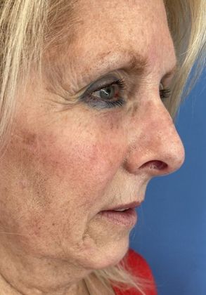 Rhinoplasty: Case 25 Rhinoplasty Fairfield, CT - Before