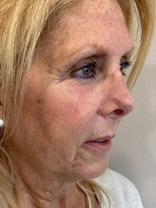 Rhinoplasty: Case 25 Rhinoplasty Fairfield, CT - After