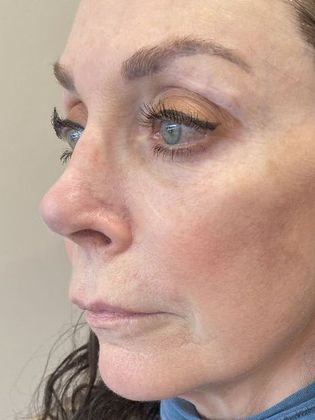 Rhinoplasty: Case 21 - Rhinoplasty, Wilton, CT - After