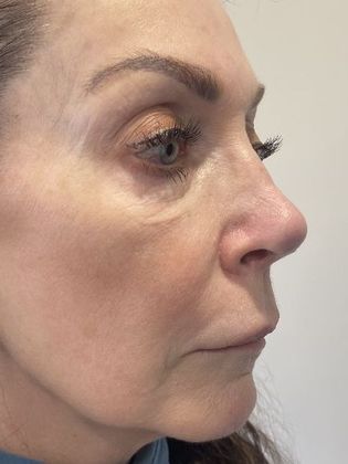 Rhinoplasty: Case 21 - Rhinoplasty, Wilton, CT - After