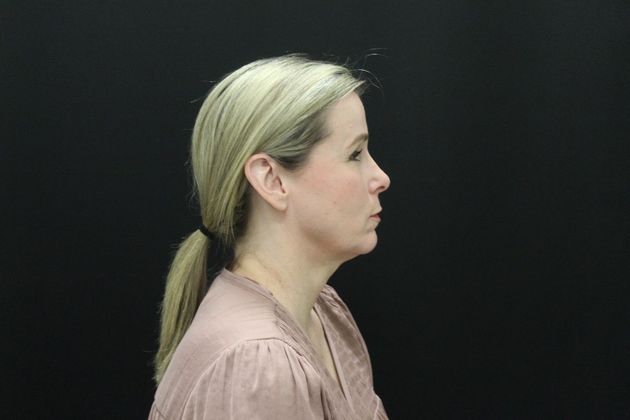 Face & Neck Lifts: Case 11 - Before