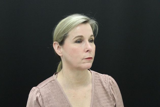 Face & Neck Lifts: Case 11 - Before