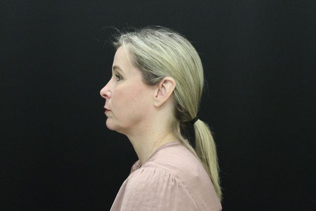 Face & Neck Lifts: Case 11 - Before