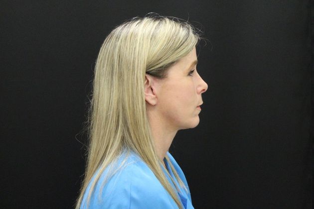 Face & Neck Lifts: Case 11 - After